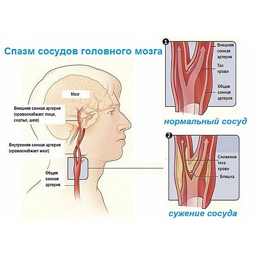 Сужение сосудов головного мозга